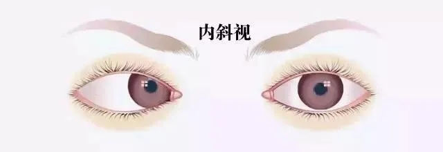 什么是斜视？