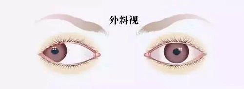 孩子眼睛有时候斜，有时候不斜，需要治疗吗？