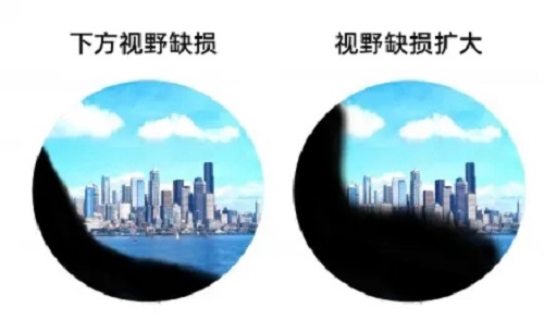 哪些人容易患视网膜脱落？