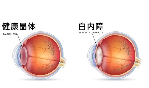 哪些眼病会遗传给下一代？